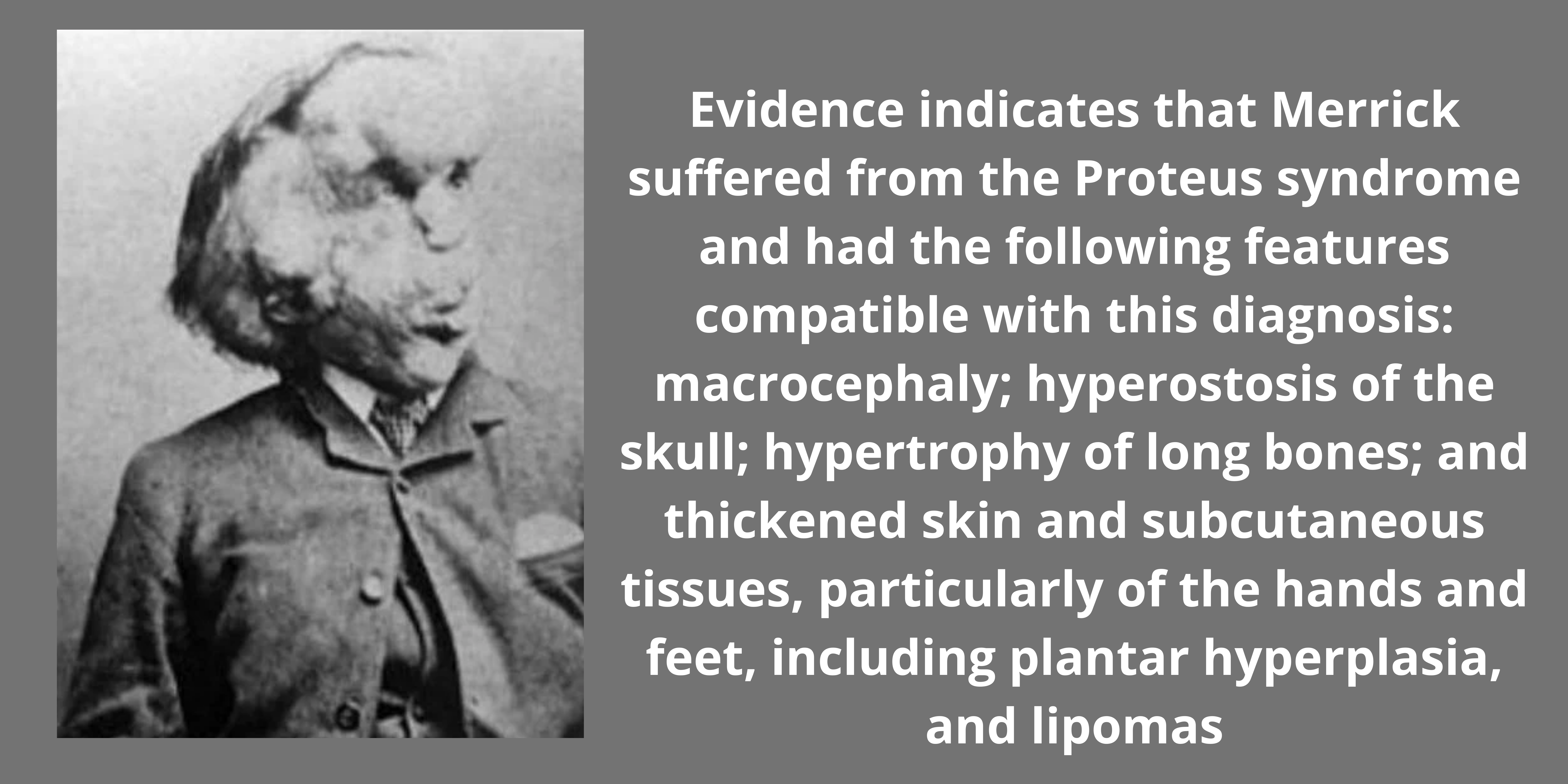 Merrick Skeleton Evidence indicates that Merrick suffered from the Proteus syndrome and ...